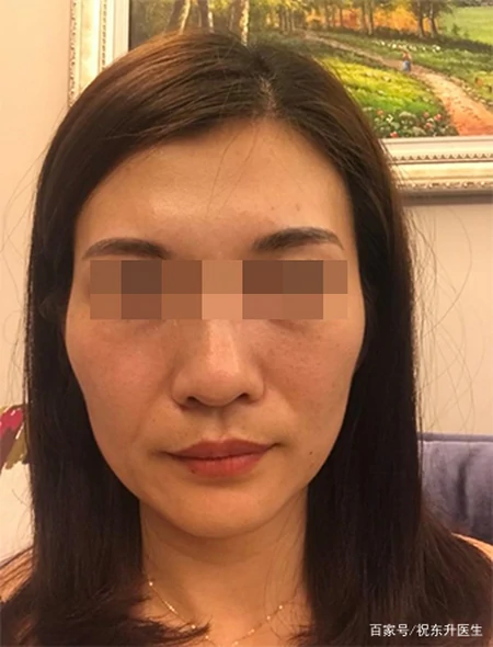 拉皮术后37天、70天，模样大不一样，从面诊到手术过程分享-拉皮术后的效果是最终效果吗