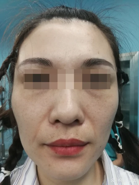 拉皮术后37天、70天，模样大不一样，从面诊到手术过程分享-拉皮术后的效果是最终效果吗