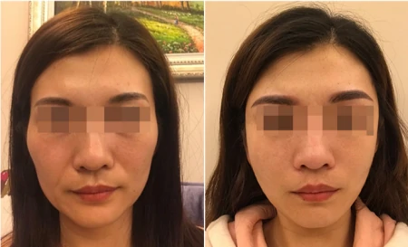 拉皮术后37天、70天，模样大不一样，从面诊到手术过程分享-拉皮术后的效果是最终效果吗