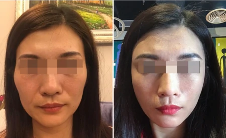 拉皮术后37天、70天，模样大不一样，从面诊到手术过程分享-拉皮术后的效果是最终效果吗