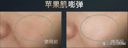 亲测！金茉美容仪怎么样？GEMO射频仪好用吗？和雅萌觅光宙斯区别-金茉cp