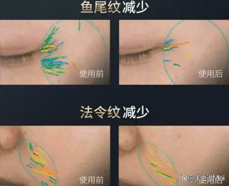 亲测！金茉美容仪怎么样？GEMO射频仪好用吗？和雅萌觅光宙斯区别-金茉cp