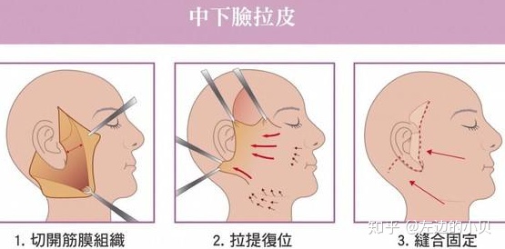 做完筋膜提升后悔了 筋膜提升的损伤太吓人了-有做过筋膜提升手术的吗?
