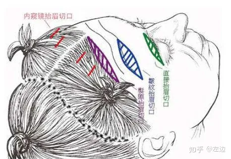 面部筋膜提升 筋膜悬吊面部提升术的效果想年轻过来看看-筋膜悬吊术治疗面瘫