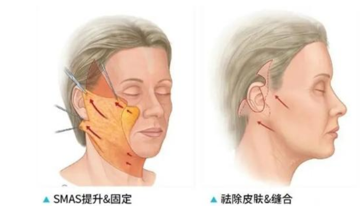 筋膜提升术有什么风险：面部筋膜提升术的危害太严重了~害怕~-面部筋膜提升32天还凹凸不平