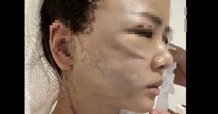 筋膜提升术有什么风险：面部筋膜提升术的危害太严重了~害怕~-面部筋膜提升32天还凹凸不平