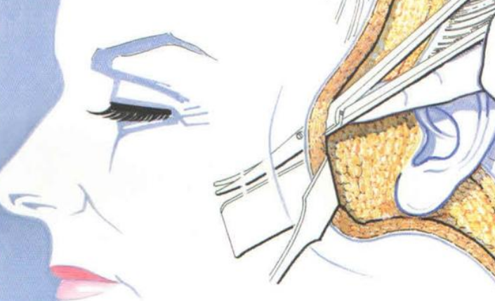 筋膜提升术有什么风险：面部筋膜提升术的危害太严重了~害怕~-面部筋膜提升32天还凹凸不平