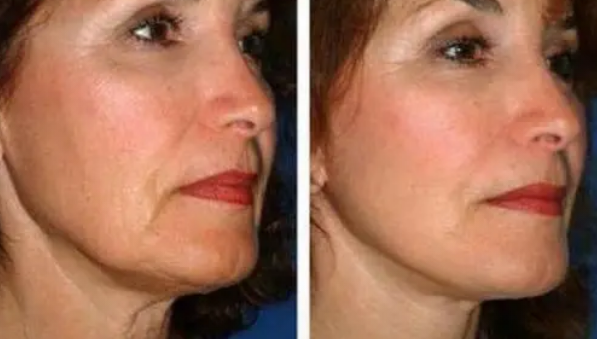 筋膜提升术有什么风险：面部筋膜提升术的危害太严重了~害怕~-面部筋膜提升32天还凹凸不平