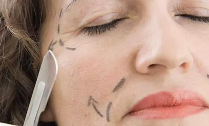 筋膜提升术有什么风险：面部筋膜提升术的危害太严重了~害怕~-面部筋膜提升32天还凹凸不平