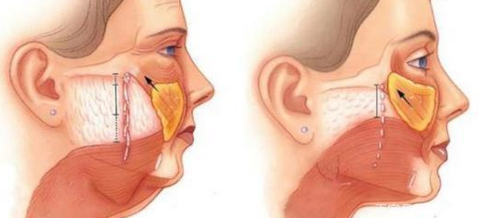 筋膜提升术有什么风险：面部筋膜提升术的危害太严重了~害怕~-面部筋膜提升32天还凹凸不平