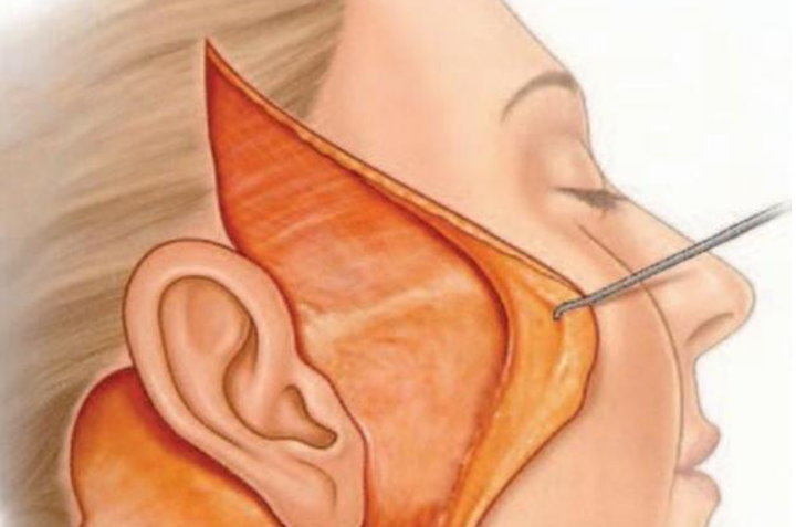 筋膜提升术有什么风险：面部筋膜提升术的危害太严重了~害怕~-面部筋膜提升32天还凹凸不平