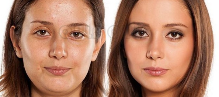 筋膜提升术有什么风险：面部筋膜提升术的危害太严重了~害怕~-面部筋膜提升32天还凹凸不平