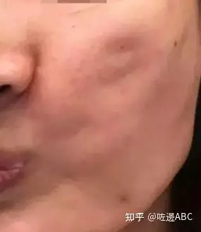 面部筋膜提升术的危害、中面部提升术的后遗症大吗，细品-筋膜提拉术手术全过程