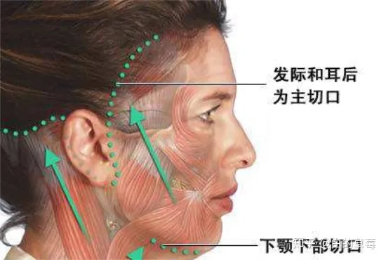 筋膜提升术、面部筋膜提升术能保持多久-面部松弛下垂提升最有效的方法