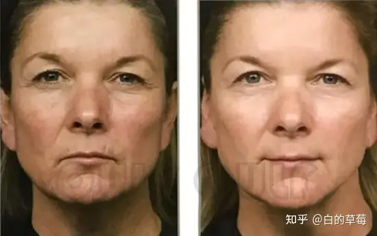 筋膜提升术、面部筋膜提升术能保持多久-面部松弛下垂提升最有效的方法