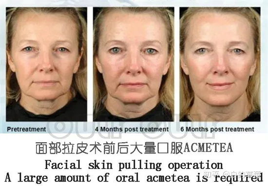 筋膜提升术、面部筋膜提升术能保持多久-面部松弛下垂提升最有效的方法