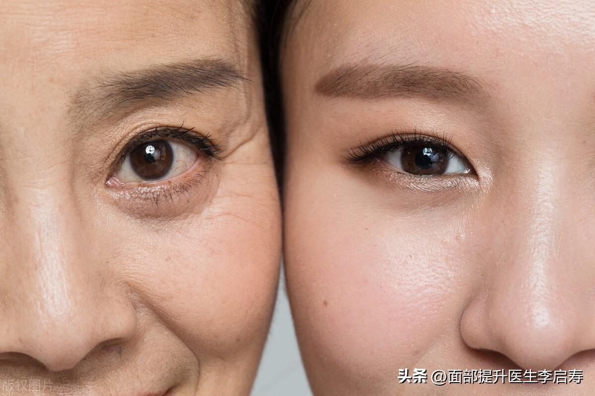 筋膜层提升是国际公认的面部提升金标准，到底什么是筋膜层提升？-筋膜提升能维持多久