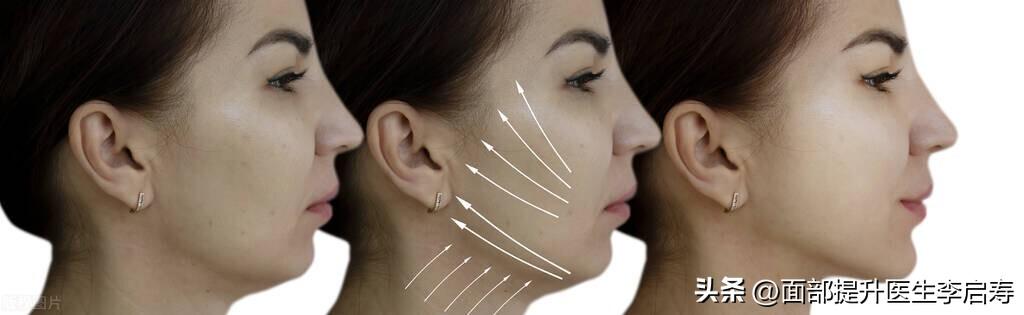 筋膜层提升是国际公认的面部提升金标准，到底什么是筋膜层提升？-筋膜提升能维持多久