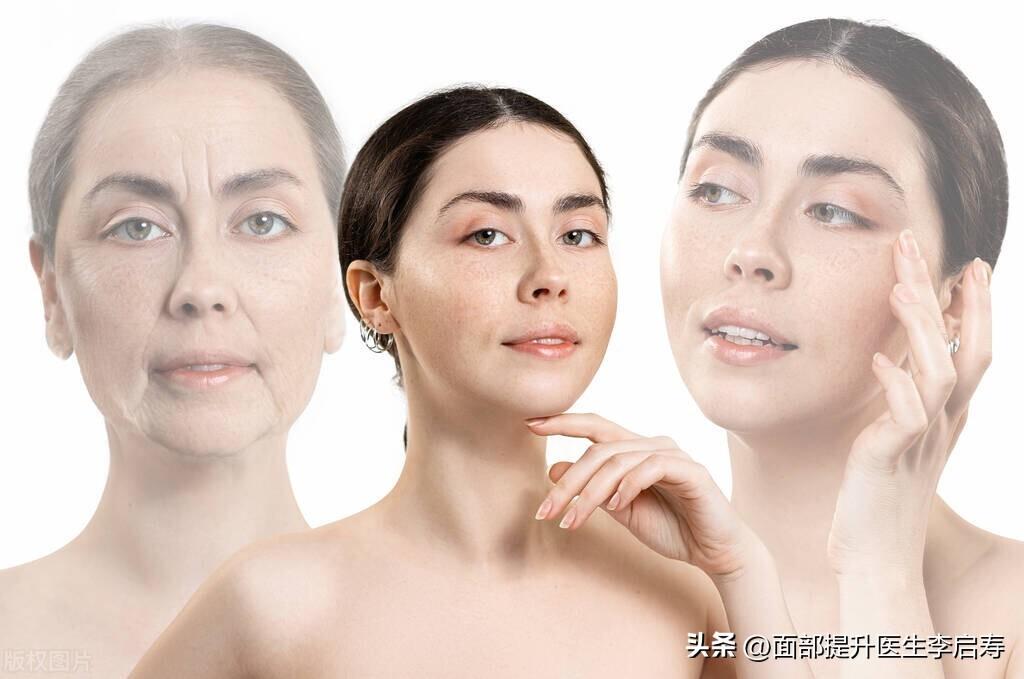 筋膜层提升是国际公认的面部提升金标准，到底什么是筋膜层提升？-筋膜提升能维持多久