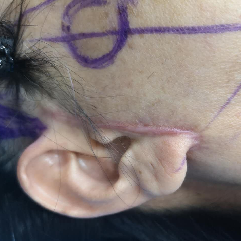 看了很多失败案例后不敢做面部提升，观望了一年才敢下定决心-如果做美容脸失败了怎么办?