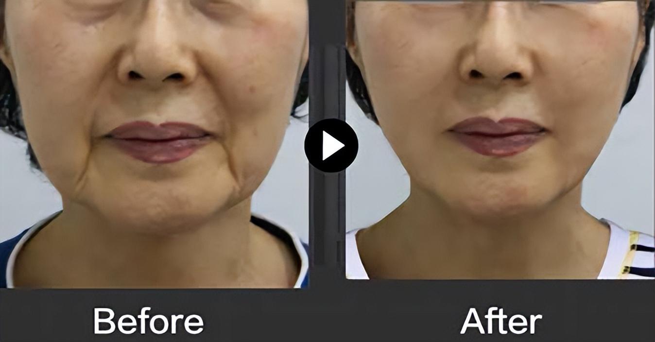 看了很多失败案例后不敢做面部提升，观望了一年才敢下定决心-如果做美容脸失败了怎么办?