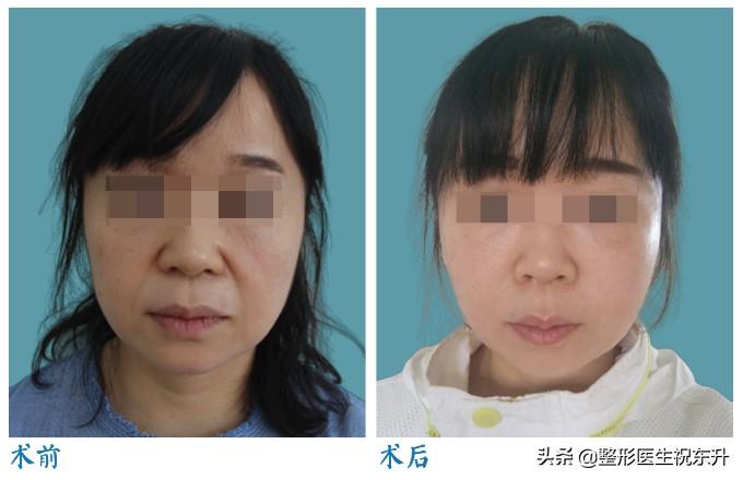 没搞清楚这25个问题，先别做"面部五层提升手术"-5d全脸提升为什么保持时间久