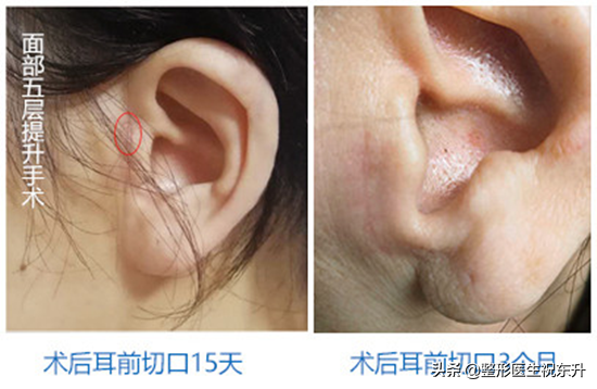 没搞清楚这25个问题，先别做"面部五层提升手术"-5d全脸提升为什么保持时间久