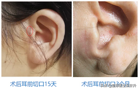 关于"面部五层提升手术"，大家问的最多的是什么？-面部五个层次