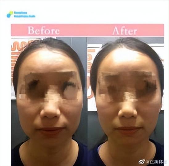 “提升面部”一定要先纠正“体态”-如何做面部提升