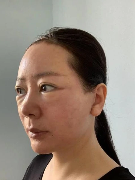 50岁鼓起勇气做拉皮，总结5点教训，句句都是大实话-五十岁女人做脸部拉皮有副作用吗