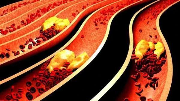 甘油三酯高的人群，少吃两物，坚持两事-甘油三酯高忌吃的食物