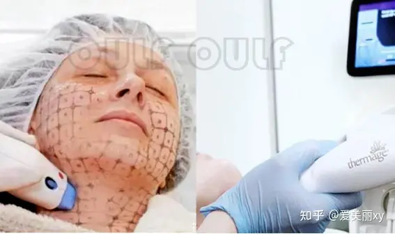 揭秘7d聚拉提大概全脸下来多少钱，7d聚拉提全脸多少钱做一次~-7d聚拉提全脸做一次能保持多久