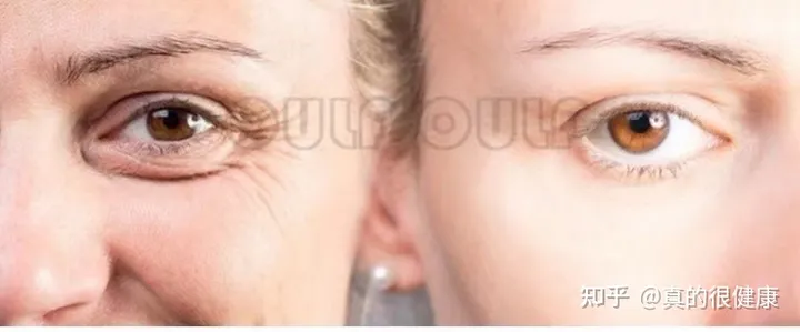 神普及：2021年7d聚拉提做全脸多少钱？7d聚拉提多久做一次？-7d聚拉提全脸多少发