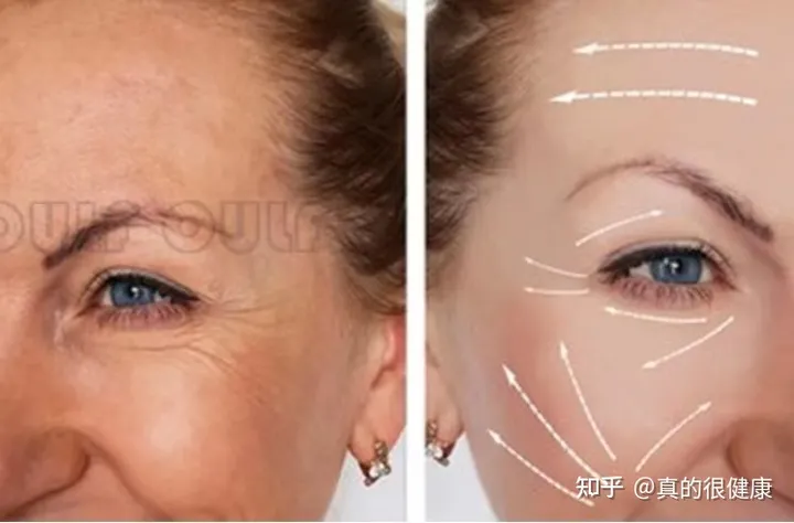 神普及：2021年7d聚拉提做全脸多少钱？7d聚拉提多久做一次？-7d聚拉提全脸多少发