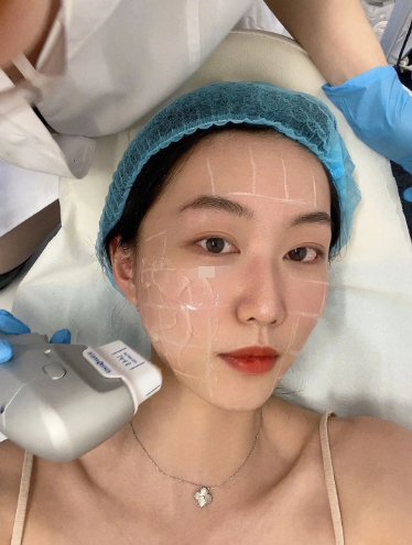 7d聚拉提全脸多少钱做一次，效果维持多久-7d聚拉提全脸是什么意思