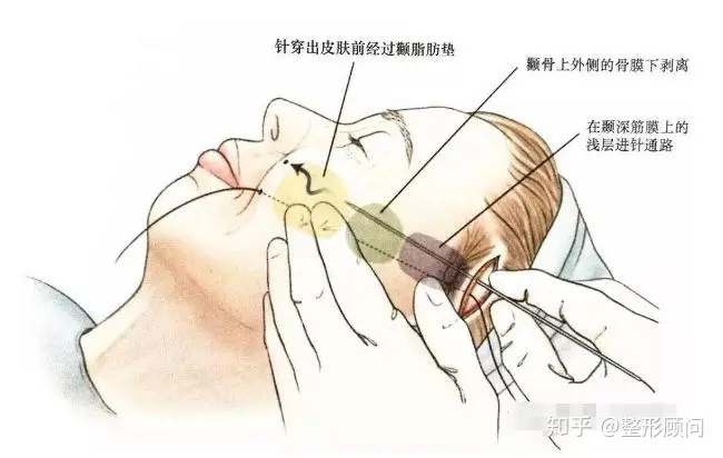 做全脸面部提升大概需要多少钱？怎么收费的？-做全脸提升美容多少钱?