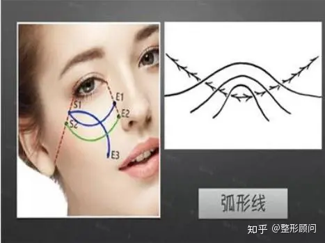 做全脸面部提升大概需要多少钱？怎么收费的？-做全脸提升美容多少钱?