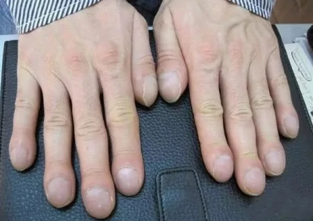 心脏有病，指甲先知？若指甲出现5个征兆，可能是心脏在“报警”-心脏病对指甲的影响