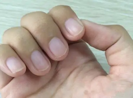 心脏有病，指甲先知？若指甲出现5个征兆，可能是心脏在“报警”-心脏病对指甲的影响