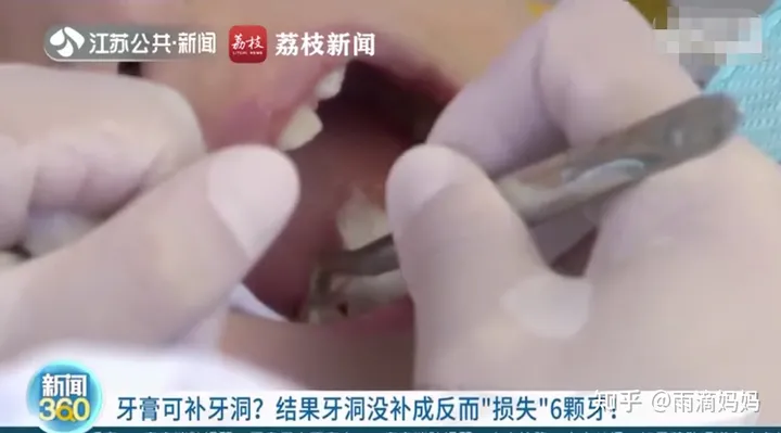 10岁娃用“牙洞修复牙膏”后损失6颗牙，这种智商税可别再交了（补洞牙膏有用吗）