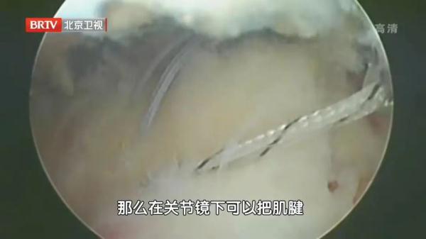 肩痛不一定是肩周炎，可能是某种致残肩病！常做一个动作，护好肩膀（肩痛怎么康复）