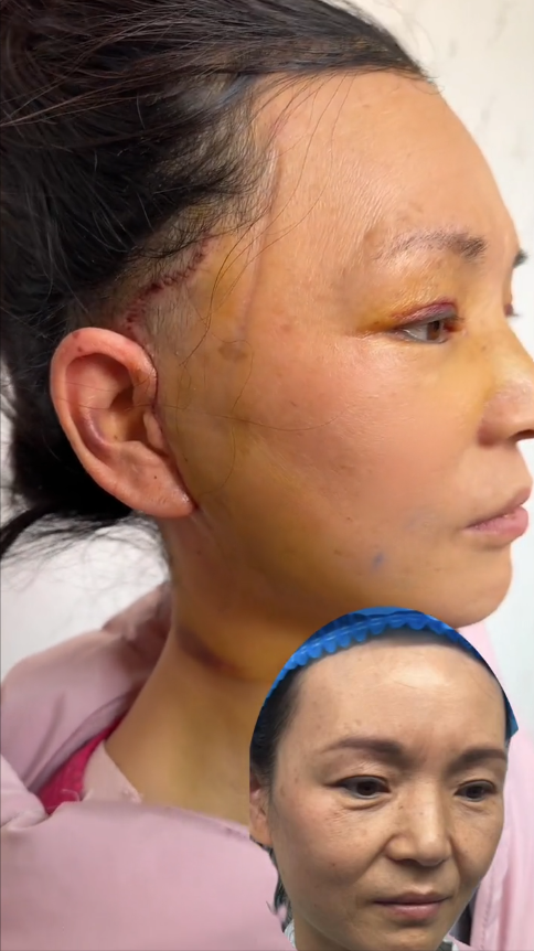 女子花几万做面部拉皮，不到一年就回落？-面部拉皮大概需要多少钱▪