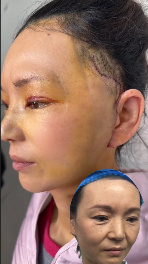 女子花几万做面部拉皮，不到一年就回落？-面部拉皮大概需要多少钱▪