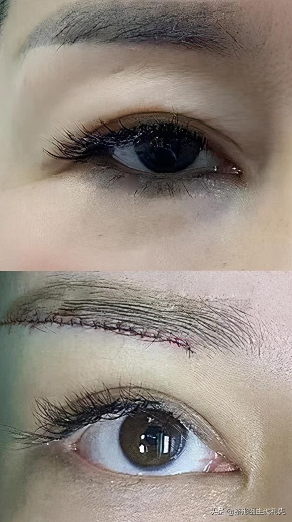 筋膜悬吊提眉手术，我49岁刚做完，给想做的姐妹们说说我的总结-筋膜悬吊提眉和普通提眉的区别