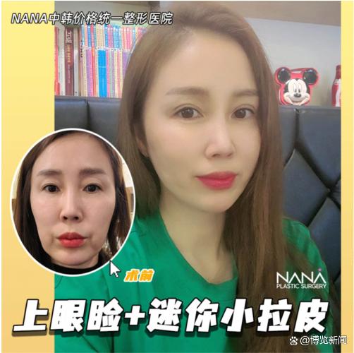 韩国NANA深层拉皮提升，逆转时光，从源头解决问题！-韩国拉皮手术一般多少钱费用