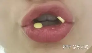 口腔溃疡怎么好得快？亲测多种治疗口腔溃疡有效的办法！-口腔溃疡怎么能尽快好
