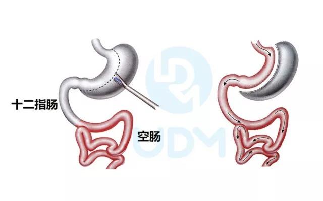 做缩胃手术一般能瘦多少斤？（缩胃手术有风险吗）