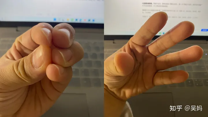 产后修复有必要做吗？-盆底肌电疗10次能修复吗