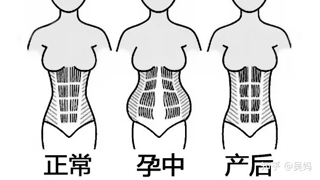 产后修复有必要做吗？-盆底肌电疗10次能修复吗