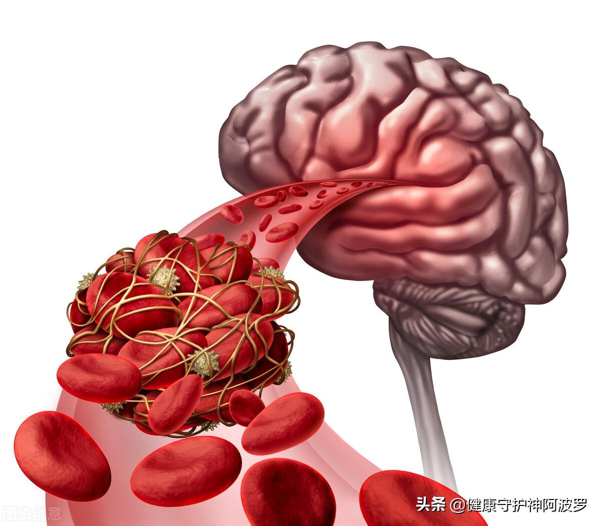 不吃药，如何才能降血压？请记住这6点-血压高不吃药怎么才能降下去